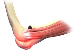 Elbow Sprain