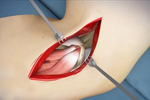 Elbow Surgery - Educational Picture