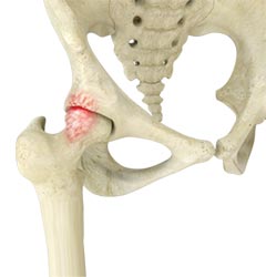 Femoroacetabular Impingement - Educational Picture