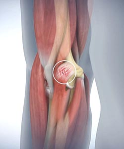 Golfer's Elbow - Educational Picture