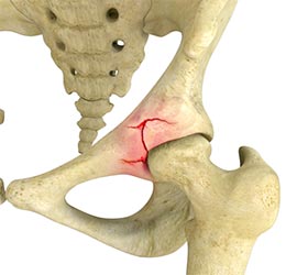 Hip Fracture - Educational Picture