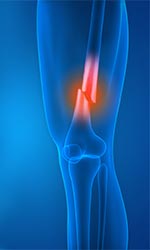 Knee Fracture