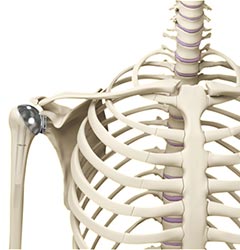 Minimally Invasive Shoulder Joint Replacement