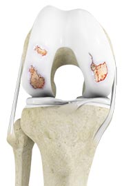 Osteoarthritis of the Hip