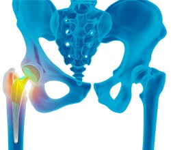 Revision Hip Replacement - Educational Picture