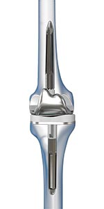 Revision Knee Replacement - Educational Picture