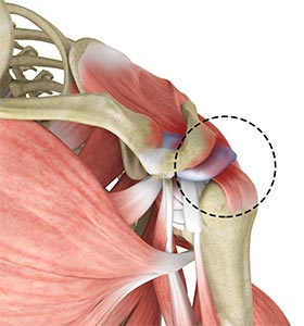 Rotator Cuff Pain - Educational Picture