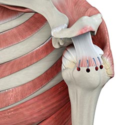 Rotator Cuff Repair - Educational Picture