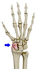 Scaphoid Fracture - Educational Picture