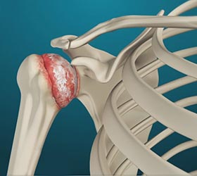 Arthritis of the Shoulder - Educational Picture