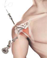 Shoulder Arthroscopy - Educational Picture
