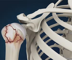 Shoulder Fracture - Educational Picture