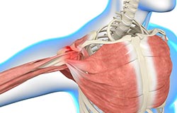 Shoulder Impingement - Educational Picture