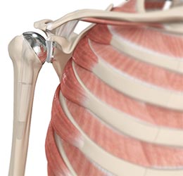 Revision Shoulder Replacement - Educational Picture