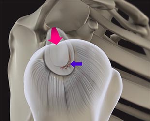 Shoulder Labral Tear with Instability - Educational Picture