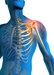 Shoulder Pain - Educational Picture