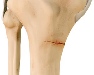 Knee Stress Fractures - Educational Picture