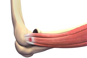 Tennis Elbow - Educational Picture