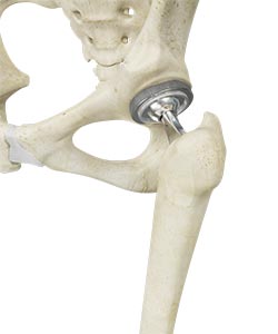 Total Hip Replacement