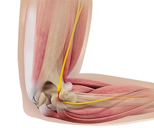 Ulnar Nerve Release - Educational Picture