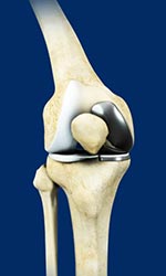 Unicondylar Knee Replacement