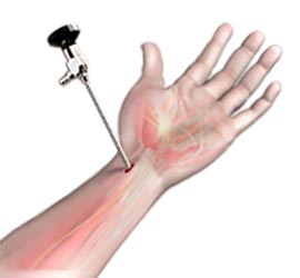 Wrist Arthroscopy