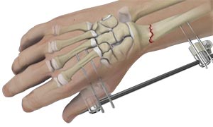 Wrist Fracture Fixation - Educational Picture