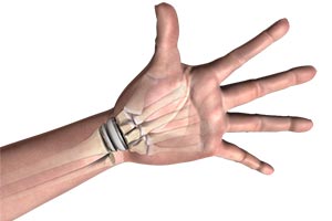 Wrist Joint Replacement