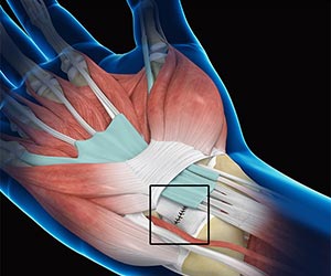Wrist Ligament Reconstruction - Educational Picture