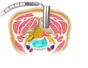 Cervical Microdiscectomy