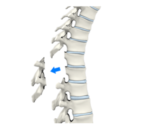 Laminectomy