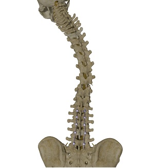 Proximal Junctional Kyphosis