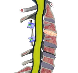 Pseudarthrosis/Nonunion