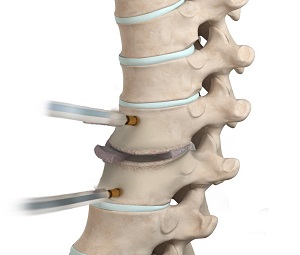 Thoracic Discectomy