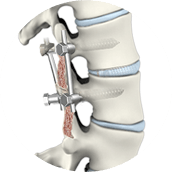 Lumbar Fusion