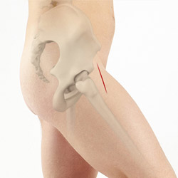 Anterior Hip Replacement