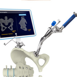 Computer Navigation for Total Hip Replacement