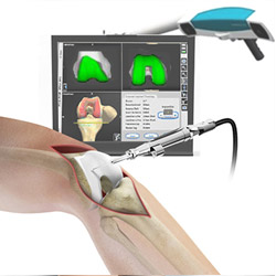 Computer Navigation for Total Knee Replacement