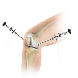 Knee Arthroscopy
