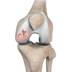 Knee Cartilage Lesions
