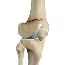 Knee Fractures