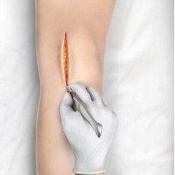 Minimally Invasive Knee Replacement