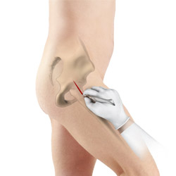 Minimally Invasive Total Hip Replacement