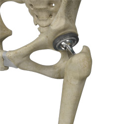 Total Hip Replacement