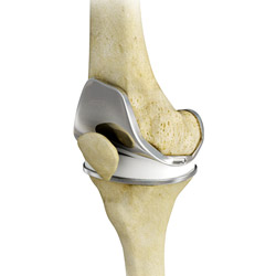 Total Knee Replacements