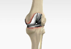 Joint Replacement FAQs