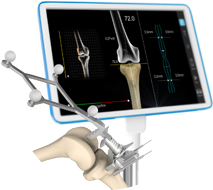 Computer-Assisted Hip & Knee Joint Replacement