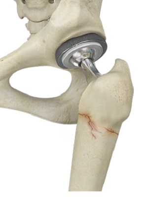 Periprosthetic Knee Fractures