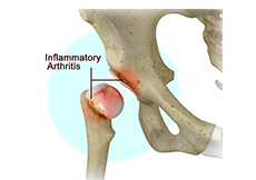 Inflammatory Arthritis of the Hip