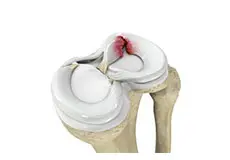 Meniscal Tears